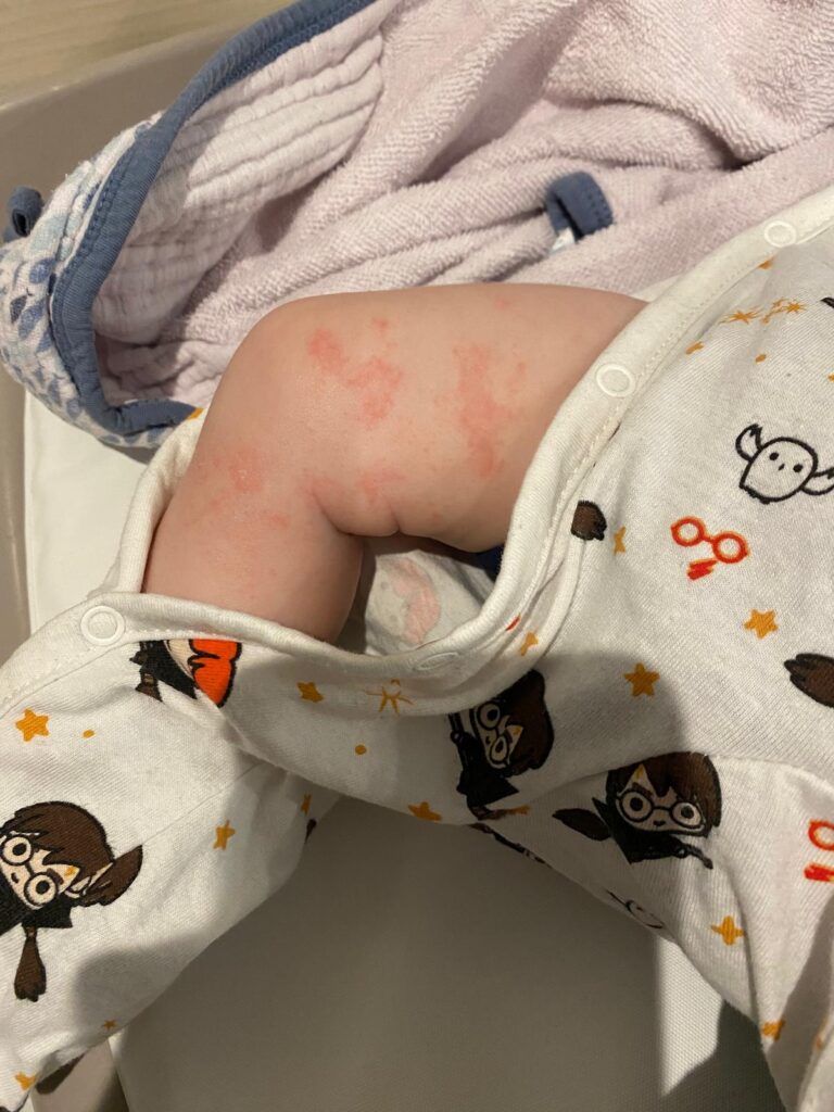 eczéma bébé solution naturelle