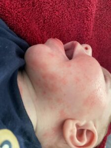 allergie bébé enfant