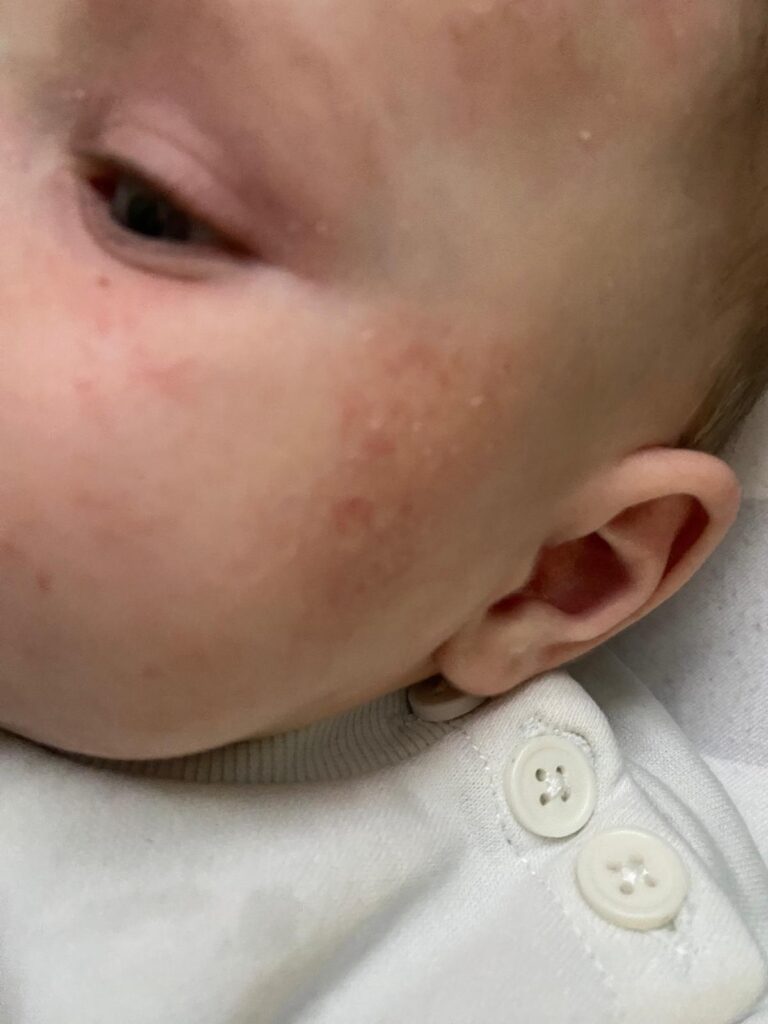 eczéma atopique bébé