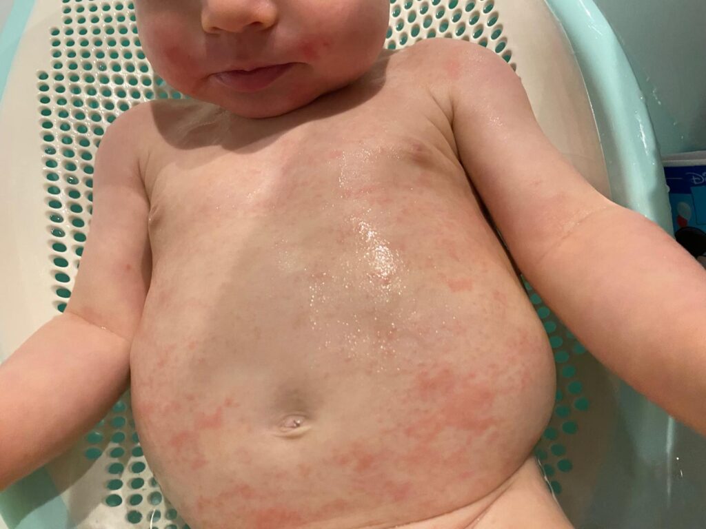 eczéma ou allergie