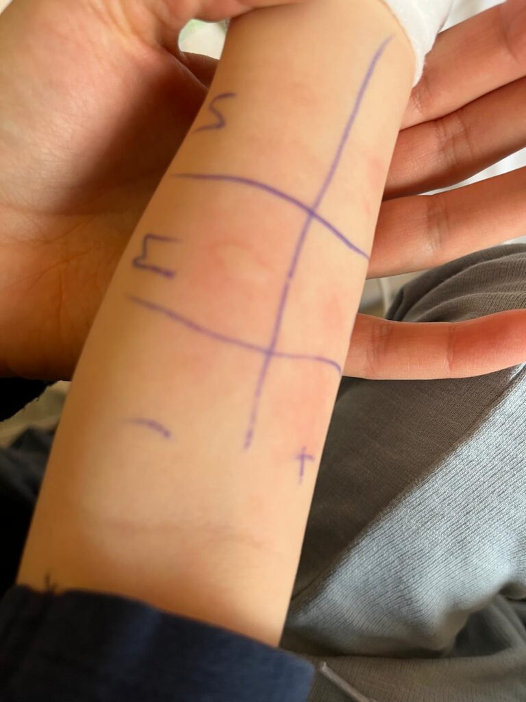 Test cutanées allergies enfant