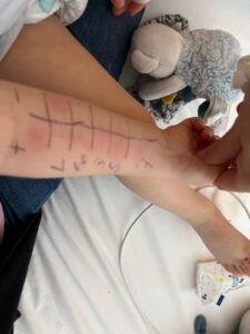 test allergies cutanées mon histoire