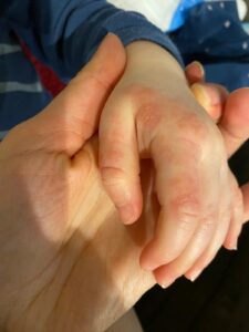 Qu’est-ce que l’eczéma ?