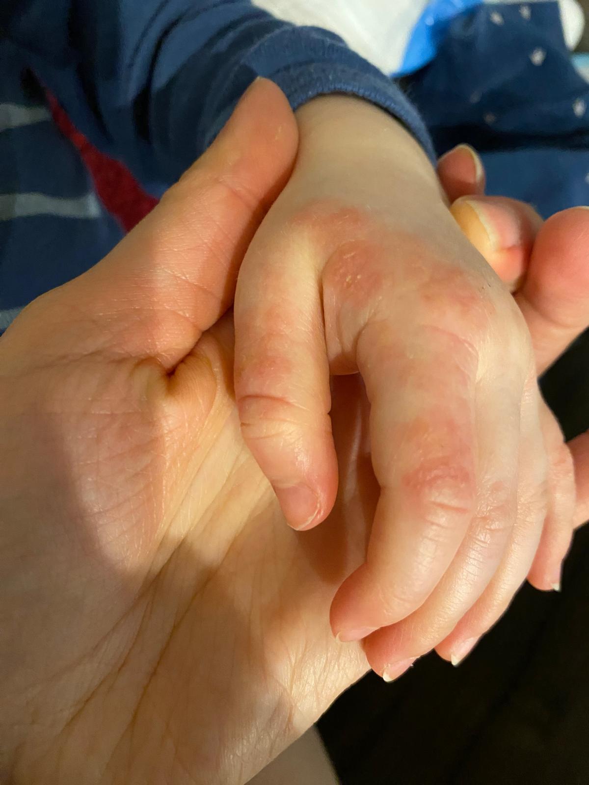 Qu’est-ce que l’eczéma ?